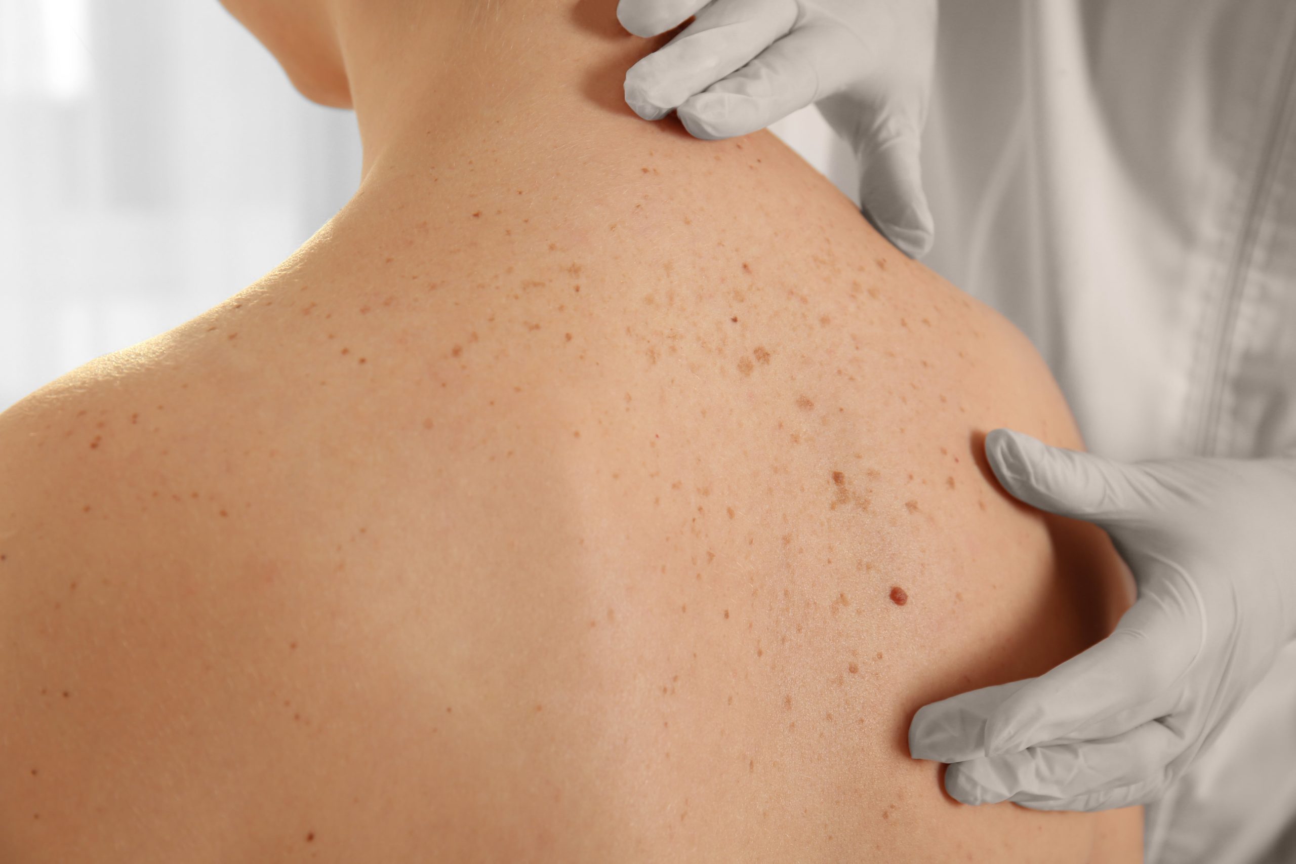 Holistic Skin Cancer Checks and Excisions