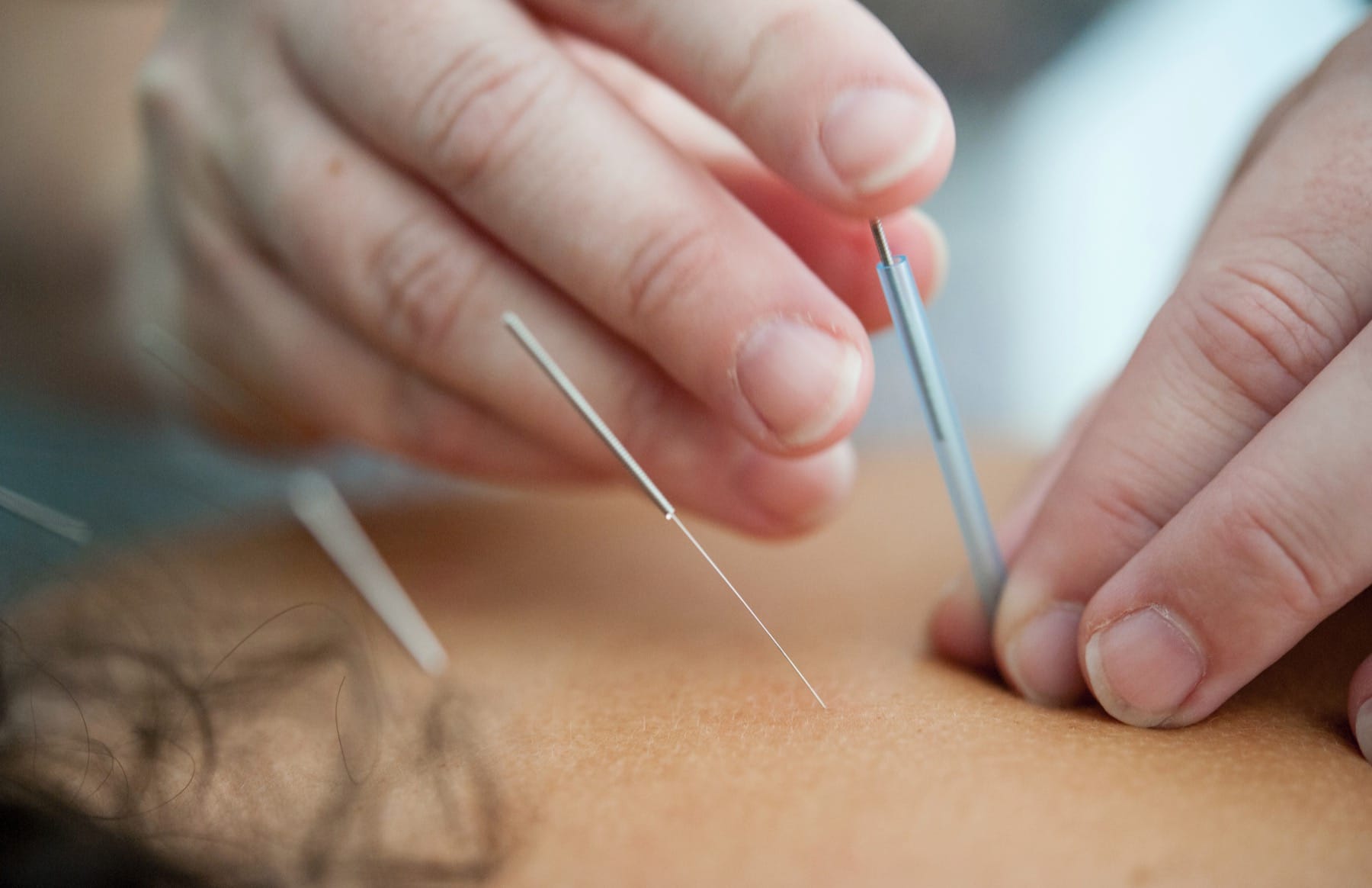 Acupuncture & Cupping