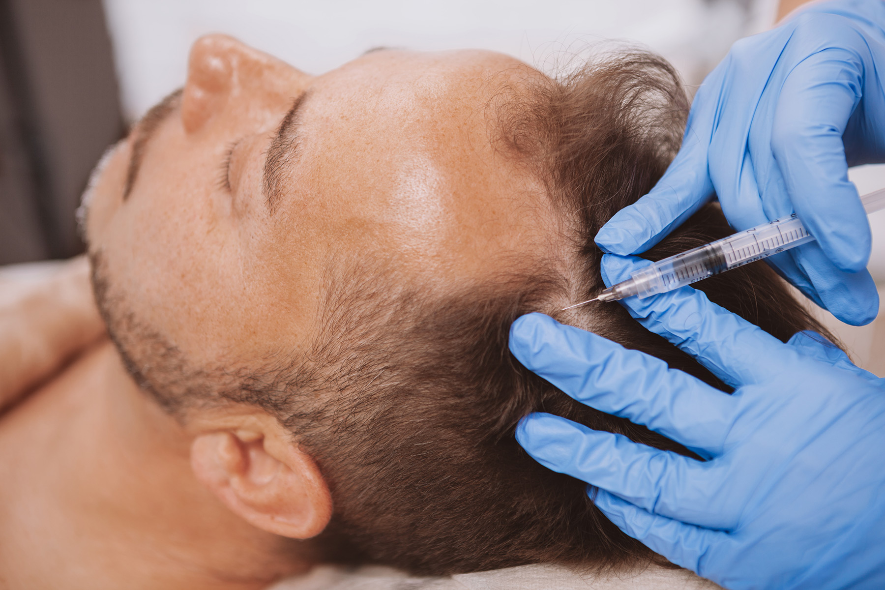 platelet-rich plasma for hair growth